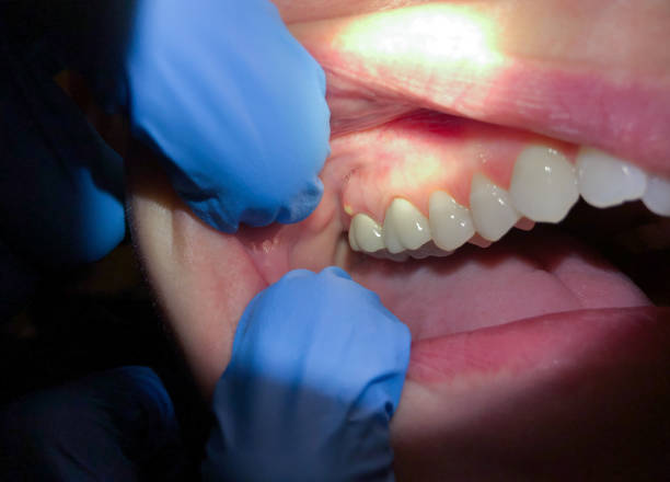 Tooth Infection Emergency Dentist in PA